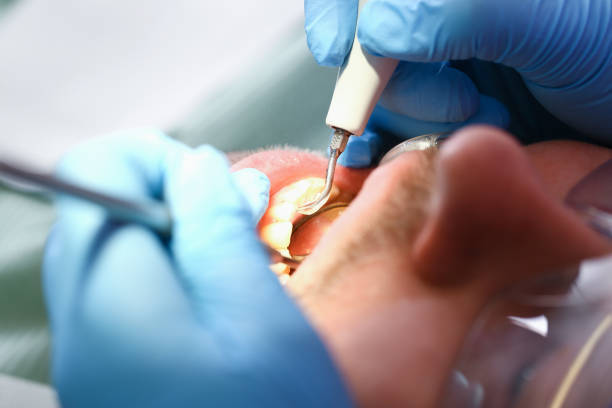 Best Emergency Wisdom Teeth Removal in Cedar Grove, WI